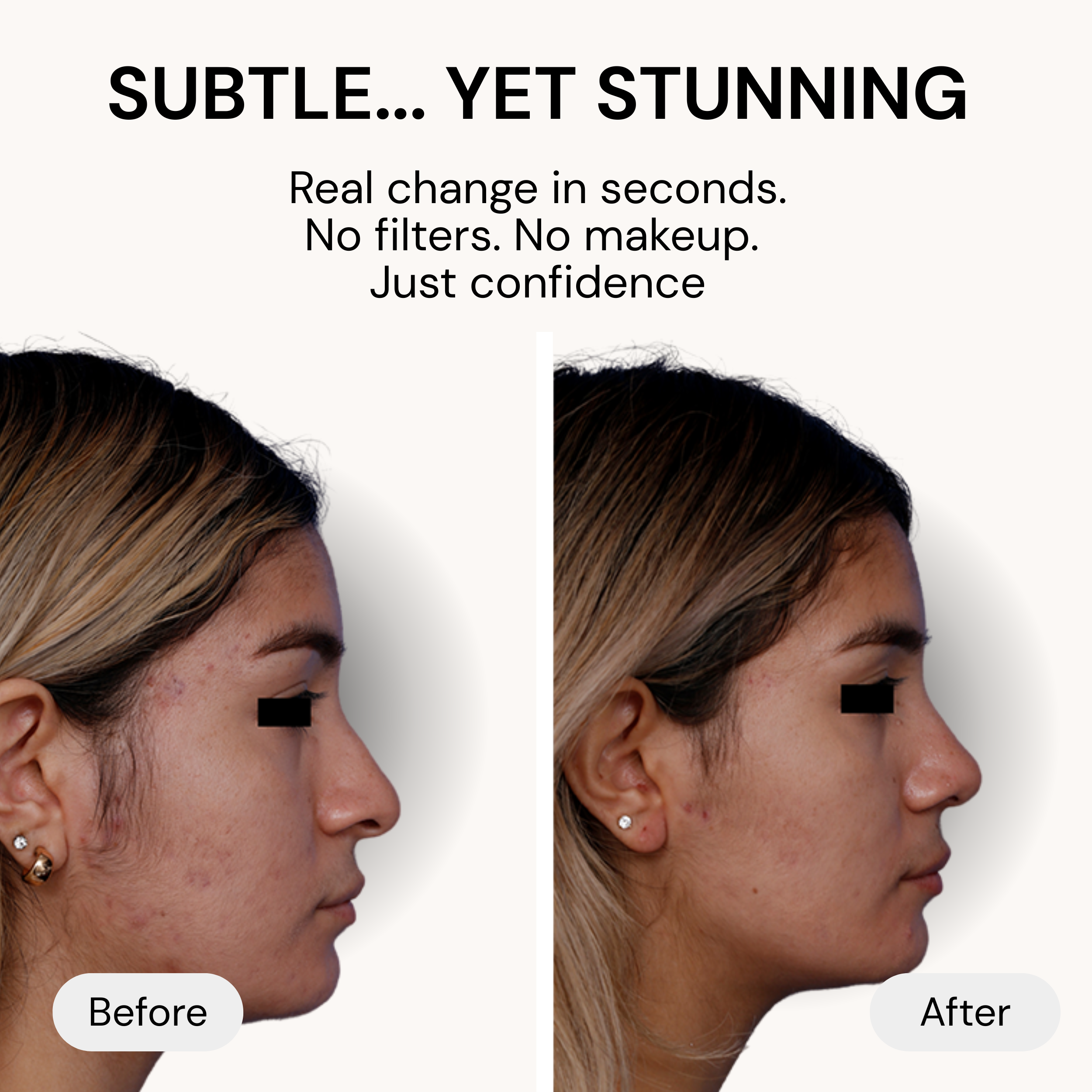 Instant Nose Lift Kit